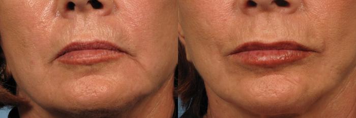 Before & After Upper Lip Lift Case 184 View #1 View in Naples and Ft. Myers, FL