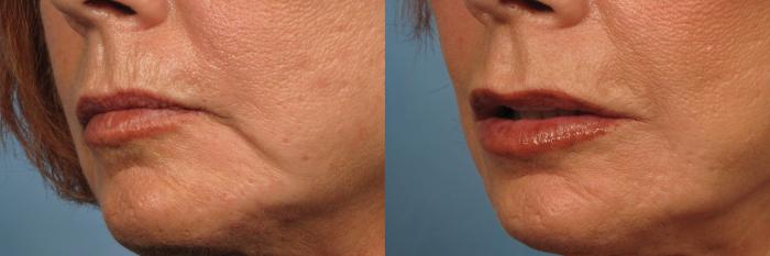 Before & After Upper Lip Lift Case 184 View #2 View in Naples and Ft. Myers, FL
