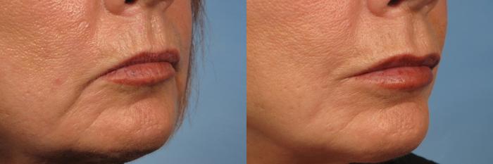 Before & After Upper Lip Lift Case 184 View #3 View in Naples and Ft. Myers, FL