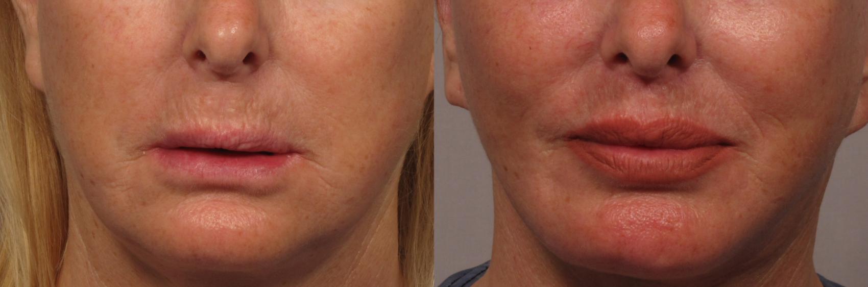 Frontal before photo of upper lip lift and fat grafting