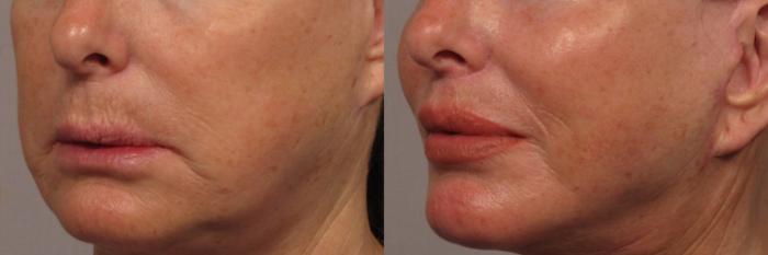Before photo of Left Oblique of Upper lip lift and fat grafting