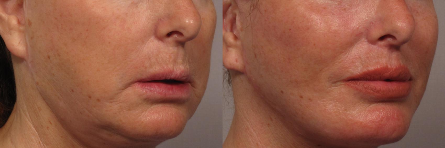 Before photo of Right Oblique of Upper lip lift and fat grafting