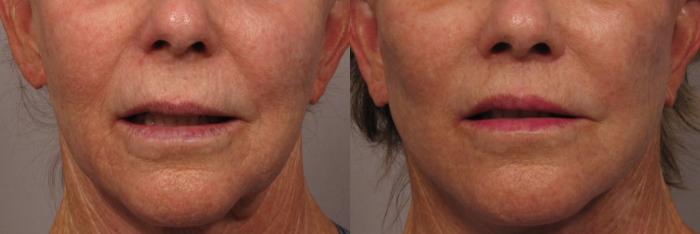 Before photo of Frontal view of Upper lip lift and fat grafting