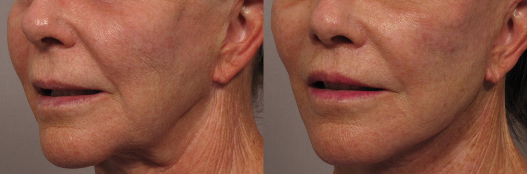 Before photo of left oblique fat grafting and upper lip lift
