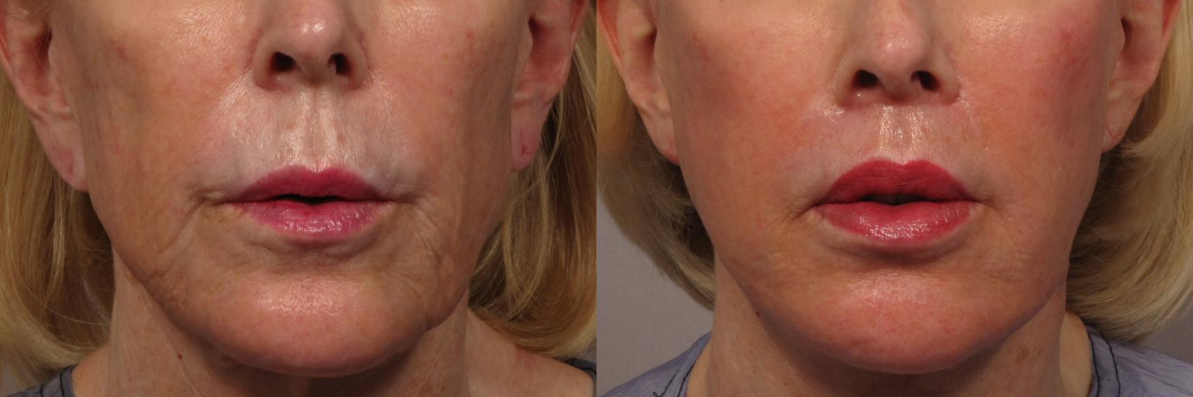 Before frontal photo of facelift, fat grafting and upper lip lift