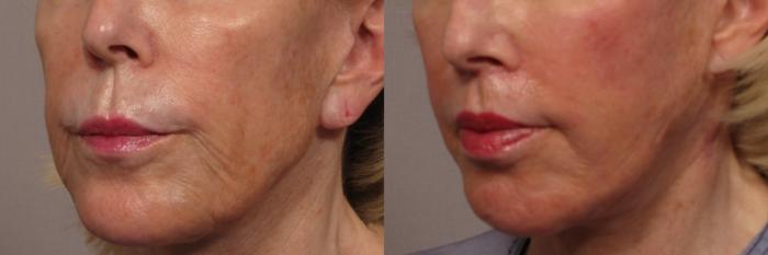 Before Left Oblique photo after facelift, fat grafting and upper lip lift