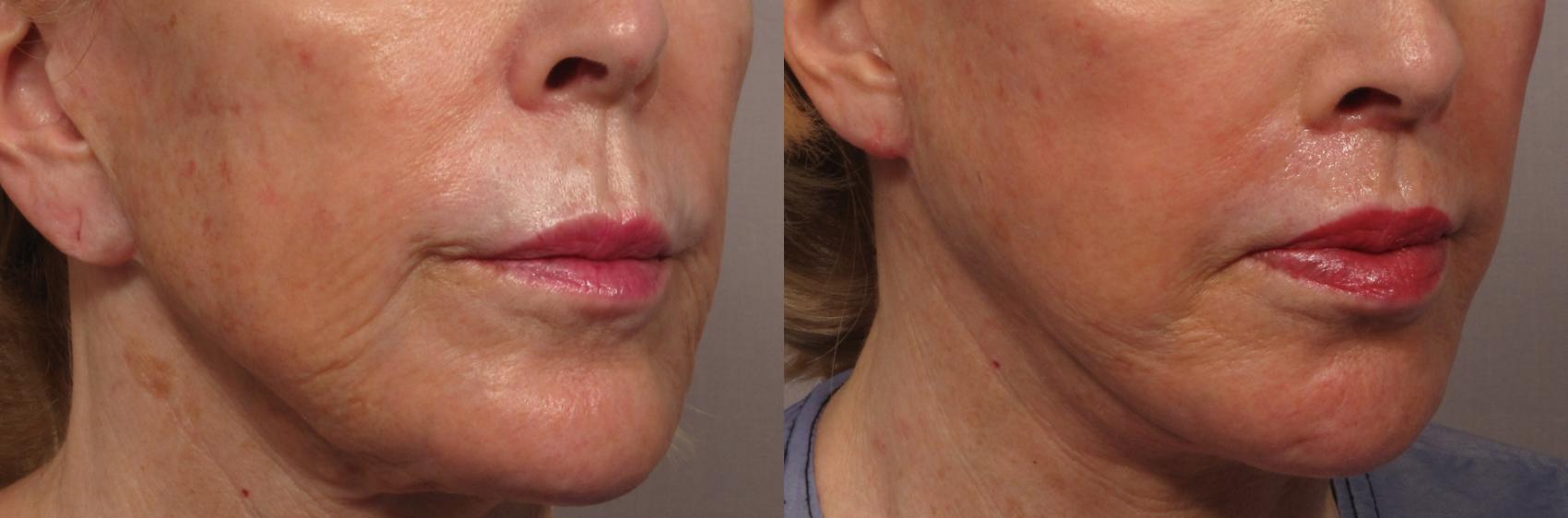 Before Right Oblique photo after facelift, fat grafting and upper lip lift
