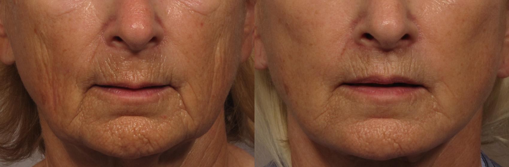Before Frontal photo of facelift with upper lip lift and fat grafting