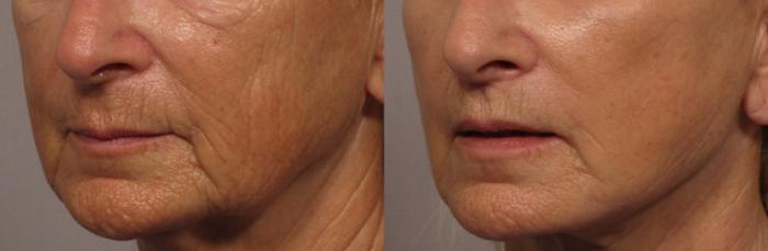 Before Left Oblique photo of facelift with upper lip lift and fat grafting