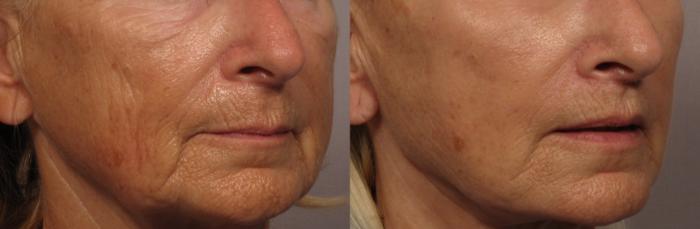 Before Right Oblique photo of facelift with upper lip lift and fat grafting